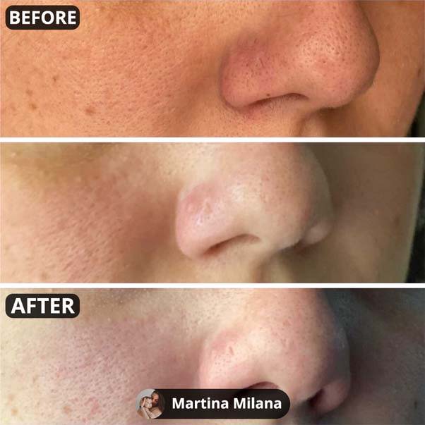 Luxury Confidence Blackhead Remover Aphrodite Blackheads Treatment Kit 2.0 White